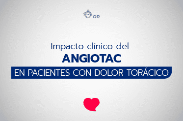 Angio tac mostrando una vista detallada de las arterias coronarias en un paciente con riesgo de enfermedades cardíacas